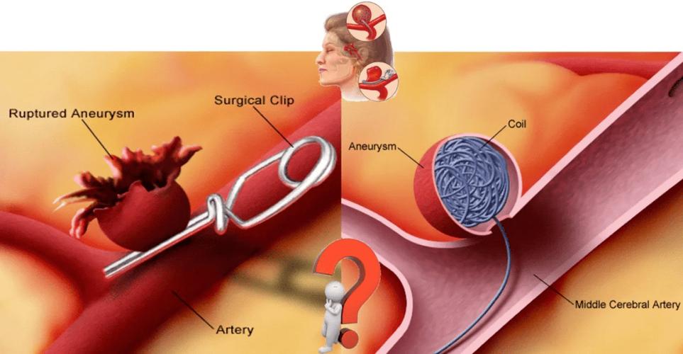 om artery stent,Understanding the Om artery stent: A Comprehensive Guide