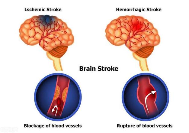 om artery blockage,Understanding Om artery Blockage: A Comprehensive Guide