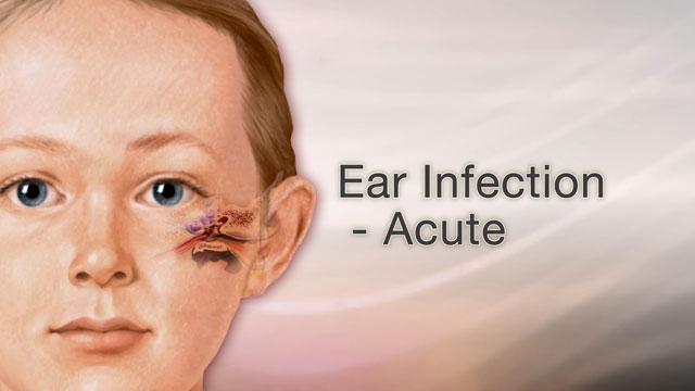 om ear infection,Understanding “OM Ear Infection”: A Comprehensive Guide